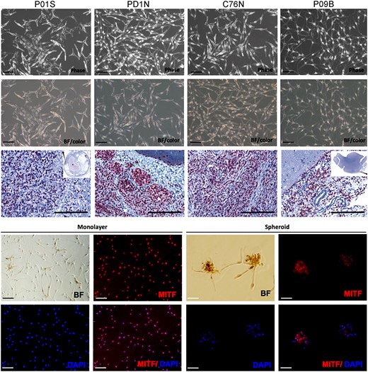 Characterization of patient-derived NCM cells. Upper panel shows phase contrast photomicrographs (Phase) of primary culture of NCM cells from melanocytic lesion of 4 patients. The second row shows bright field (BF/color) pictures of the same cells showing the presence of brown melanin pigment (scale bar = 50 μm). Third row shows MiTF immunohistochemistry with diaminobenzidine chromogen and Mayer's hematoxylin counterstain in lesional tissues from where each NCM cell line derives. P01S: spinal cord, PD1N: skin, C76N: skin, P09B: brain (scanned image, H&E, 0.6×, scale bar = 200 μm). The 2 lower rows show BF pictures and MiTF (red) immunofluorescence in nevocytes cultured as monolayer and spheroids. Nuclei are counterstained with DAPI (4′,6-diamidino-2-phenylindole). Scale bar represents 50 μm.