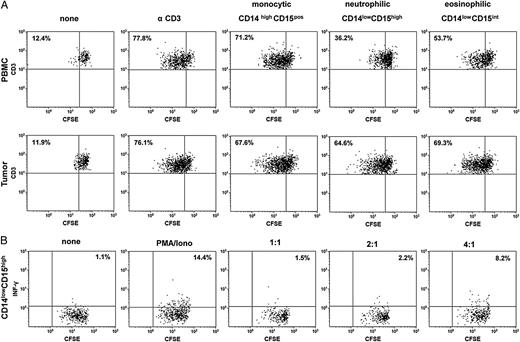 Suppressive capacity of different myeloid-derived suppressor cell (MDSC) subsets from partiipants with primary glioblastoma. Peripheral blood mononuclear cells (PBMCs) and tumor cell suspensions were stained with CD45, CD11b, CD14, and CD15, and different MDSC subsets were sorted, seeded into anti-CD3–coated plates and co-cultured with CFSE-labeled autologous T-cells at a T-cell-to-MDSC ratio of 2:1 in the presence of IL-2. Five days later, T-cell proliferation was assessed by flow cytometry. (A) Representative dot plots of T-cell proliferation after addition of CD14highCD15pos monocytic, CD14lowCD15high neutrophilic, and CD14lowCD15int MDSCs from the same participant are shown. The percentage values represent the fraction of proliferating CSFE-labeled T-cells. (B) Representative dot plots of T-cell proliferation and intracellular INF-γ secretion after addition of CD14lowCD15high neutrophilic MDSCs to CFSE-labeled autologous T-cells at different T-cell -to- MDSC ratios (1:1–4:1) and PMA/ionomycin stimulation. The percentage values represent the fraction of INF-γ secreting CSFE-labeled T-cells. Data are representative of 3 independent experiments done.