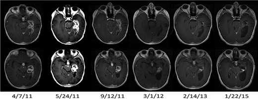 MRI results (T1-weighted gadolinium-enhanced axial images) in a responding patient (Patient 4) with transient pseudoprogression. Baseline scan date is 4/7/11. Pseudoprogression was apparent on the scan after 2 vaccines (5/24/11). Scans from subsequent dates show regression of leptomeningeal and subependymal enhancement and decreased size of the primary tumor, which has persisted over time. The PR status has been maintained for >57 mo after diagnosis.