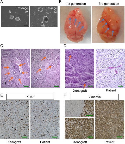 Pathological characterization of patient-derived malignant meningioma model MN3. (A) Microscopic pictures of MN3 tumorspheres cultured at passages 0 and 2. Scale bars, 100 µm. (B) Macroscopic appearance of lethal subdurally transplanted MN3 tumors located at the frontal region of mouse brains. Left, first generation. Right, third generation. Arrows point to brain-tumor boundaries. (C) H&E staining of MN3 xenografts showing whorl formation by tumor cells (left, arrows) and irregular tongue-like protrusions indicative of invasion to the brain (right, arrows). T, tumor; B, brain. Scale bars, 200 µm. (D) Higher magnification pictures of H&E-stained MN3 xenografts (left) and patient tumor sections (right), showing histological similarities between the two. Arrows show mitoses. (E and F) Immunohistochemistry for Ki67 (MIB-1) and vimentin, showing high proliferative activity and mesenchymal protein expression, respectively, in the matched patient (right) and xenograft (left). Left panels in (F) show a tumor–brain interface with negative staining in the brain parenchyma on the left (upper panel) and homogeneous staining at the tumor core (lower panel). Scale bars in (D)–(F), 100 µm.