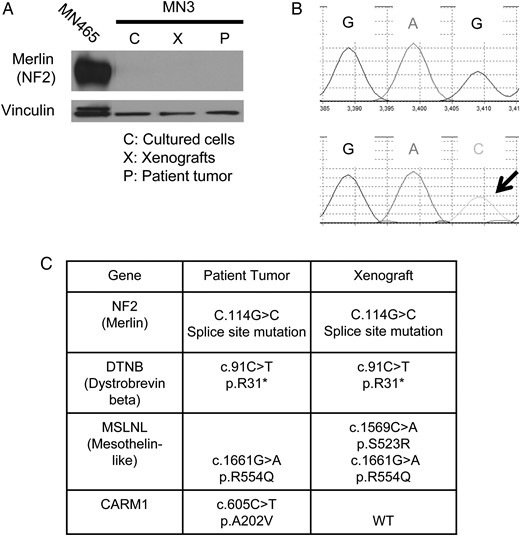 Molecular characterization of the MN3 meningioma model. (A) Western blot for the NF2 product merlin in the patient tumor, xenografts, and cultured cells. MN465 cells were used as a positive control for merlin. Vinculin was used as a loading control. Irrelevant lanes between the lanes of MN465 and MN3 were removed during image processing of the blot. (B) Genomic PCR-based sequencing showing G to C alteration at C.114 in NF2 in the xenograft DNA. (C) Summary of mutation status of NF2, DTNB, MSLNL, and CARM1 in the patient tumor (whole exome sequencing) and xenografts (fourth generation, focused sequencing). WT, wild type.