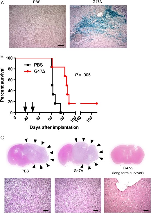 In vivo efficacy of oHSV G47Δ in orthotopic MN3 xenografts. (A) X-gal staining of MN3 xenografts 24 h after injection of phosphate buffered saline (PBS, left) or G47Δ (1 × 106 pfu/3 µL, right). Scale bars, 100 µm. (B) Kaplan–Meier analysis showing significant extension of mouse survival after 2 intratumoral injections of G47Δ (2 × 106 pfu/3 µL each) vs PBS (n = 6/group) in the orthotopic MN3 xenograft model. Arrows show the times when G47Δ or PBS was injected (days 14 and 25 after tumor cell implantation). One animal in the G47Δ group survived long without exhibiting symptoms and was euthanized on day 169. (C) H&E staining of brain sections (upper panels) and microscopic images (lower panels) prepared from representative animals in the survival study shown as (B). Left, PBS treated, and middle, G47Δ treated, show growth of large and lethal tumors (pointed to by arrowheads), while right, G47Δ treated, reveals a small tissue defect near the implantation site with no sign of tumor.