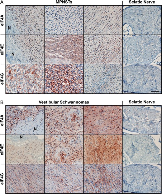 Malignant peripheral nerve sheath tumors (MPNSTs) and vestibular schwannomas (VSs) overexpress all 3 eIF4F components. Shown are representative images for MPNST (A) and VS (B) sections immunostained for eIF4A, eIF4E and eIF4G. “N” indicates adjacent normal nerve tissues. Immunostaining of normal sciatic nerve sections served as controls. The relative staining signals from all samples are summarized in Supplementary Table S3. Scale bar is 200 μm. For high-magnification images, see Supplementary Fig. S1.