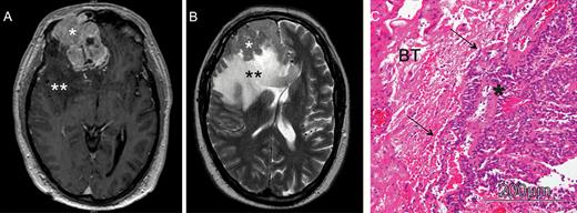 Illustrative cranial MRI of a patient with a brain invasive meningioma. (A) Preoperative, axial post-gadolinium (GD) T1-weighted MRI revealing a large right frontal, contrast-enhancing meningioma. (B) Axial T2-weighted image shows the distinct peritumoral edema. In neuropathological analyses, the tumor showed finger-like invasion into the adjacent brain tissue (C; hematoxylin and eosin staining); *meningioma; **peritumoral brain edema; BT, brain tissue.