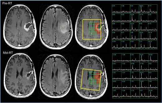 Anatomic images and metabolic data from patient A, a 41-year-old patient with KPS = 80, PFS = 67 days, and OS = 305 days. The pre-RT images indicate a subtotal resection with residual CE on the medial side of the cavity and a larger T2 lesion. The mid-RT images show that the cavity has contracted and there is reduced mass effect. The color overlays of the CNI parameters are thresholded to show only regions with CNI >2. The selected volume is highlighted in yellow. These and the spectral arrays highlight the region with abnormal metabolism, which has highly elevated choline, reduced NAA, with increased lipid in the cavity. Note that although the images and spectra were registered to improve visualization of the effects, the calculation of the quantitative parameters was done in the original coordinate frame.