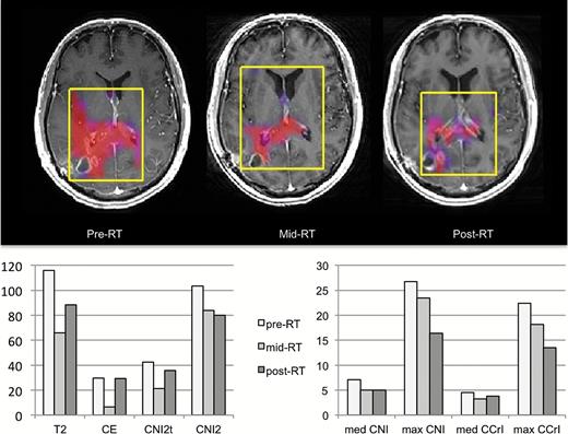 Patient B was 58 years old with KPS = 80, PFS = 191 days, and OS = 269 days. Color overlays of CNI values on postcontrast T1-weighted images obtained at pre-, mid-, and post-RT scans and bar plots of changes in parameter values are shown. The overlays were thresholded to show only regions with CNI >2. The selected volumes are highlighted in yellow. The volumes of the T2 and CE lesions show an initial decrease and then an increase. The spatial extent of the metabolic lesion (CNI >2) and the maximum intensities of CNI and CCrI show a consistent decrease with time, suggesting an initial response to the treatment given.
