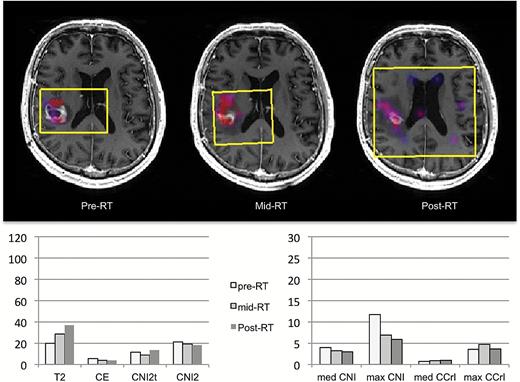 Patient C was 50 years old with KPS = 90, PFS = 364 days, and OS = 546 days. Color overlays of CNI values on postcontrast T1-weighted images obtained at pre-, mid-, and post-RT scans are shown. The overlays were thresholded to show only regions with CNI >2. The selected volumes are highlighted in yellow. The spatial extent and magnitude of the regions with abnormal metabolism are much smaller than those for patient B, indicating much smaller metabolic lesions that further reduce with treatment. The patterns of changes in parameter values are seen in the bar graphs below.