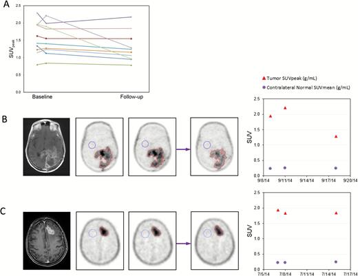 18F-FLT PET imaging. (A) Synopsis of SUVpeak values of double-baseline and values after 7 days of treatment with mibefradil. (B and C) Examples of a patient with significant decline in SUV after 7 days of MIB (B) and a patient without a decline (C). MRI T1 contrast-enhanced image corresponding to the images of 18F-FLT PET imaging shown. Double baseline scans (left, 2 18F-FLT PET images), followed by 7 days on mibefradil and repeat imaging on day 7 (right, 18F-FLT PET images). Far right: changes in SUV values.