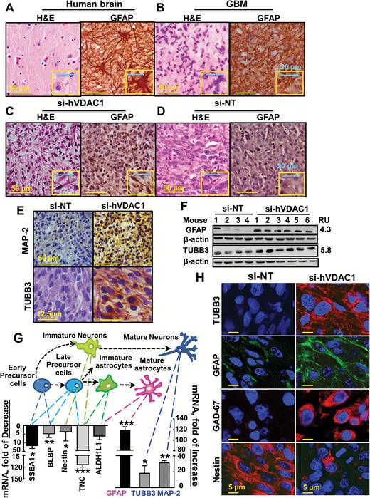 U-87MG cells in si-hVDAC1-TTs: morphological changes and expression of neuronal markers. Human normal (A), GBM brains (B), or hVDAC1-TTs (C) or si-NT-TTs (s.c.) (D) stained with H&E or anti-GFAP antibodies. (E) si-hVDAC1-TTs or si-NT-TTs sections stained with anti–Map-2 or anti-TUBB3 antibodies. (F) Immunoblot of GFAP and TUBB3 in si-NT-TTs and si-hVDAC1-TTs. RU = relative units. (G) Schematic presentation of early precursor cell differentiation into mature astrocytes via several possible intermediate states: late precursor cells, immature astrocytes, or neurons via immature neurons. Levels of mRNA markers specific for each state in s.c. si-hVDAC1-TTs relative to those in si-NT-TTs are presented. Results are the mean±SEM (n = 3–5); *P ≤ .05; **P ≤ .01; ***P ≤ .001. (H) Immunofluorescent staining of si-NT-TT– and si-hVDAC1-TT–derived sections for nestin, GFAP, TUBB3, and GAD67.