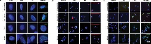 Effects of DSF on the DNA damage and autophagy of irradiated AT/RT cells. (A) γ-H2AX foci-positive cells (green) in each group were compared by immunofluorescence (n = 3 for each group). Scale bar, 10 μm. (B) Apoptosis was confirmed by cleaved caspase-3-stained cells (red) by immunofluorescence (n = 3 for each group). Scale bar, 50 μm. (C) The autophagy-induced cells were observed by Cyto-ID uptake (green). Scale bar, 30 μm. Nuclei were counterstained with 4′,6′-diamidino-2-phenylindole (DAPI, blue). All of the experiments were performed in SNU.AT/RT-5, SNU.AT/RT-6, BT-12, and BT-16 cells.