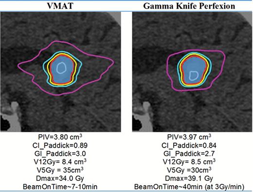 A typical dose distribution and resulting statistics for a single target shown in sagittal view. Blue colorwash = target volume; isodose lines: gray = 30 Gy, red = 20 Gy (prescribed dose); yellow = 16 Gy; light blue = 12 Gy; pink = 5 Gy. VMAT was planned using a 2-arc RapidArc Varian linac with HD 120 MLC. Plans were generated such that the target volume receiving 20 Gy was 98%.