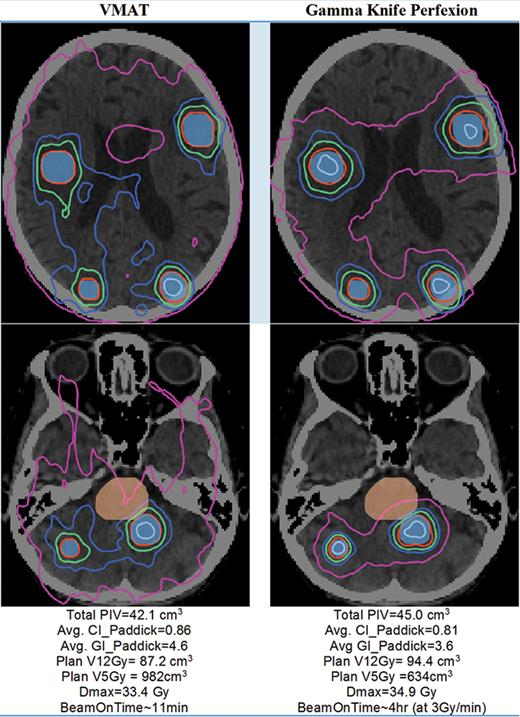 Sample dose distribution for a 9-target case shown in axial view (2 separate slices). Blue colorwash = target volume; orange colorwash = brainstem. Isodose lines: gray = 28 Gy, red = 18 Gy (prescribed dose); green = 12 Gy; blue = 9 Gy; pink = 5 Gy. VMAT was planned using 4 arcs RapidArc on a Varian linac with HD 120 MLC.