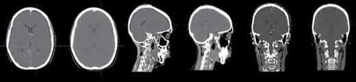 MRCT (left) and actual CT (right) axial, sagittal, and coronal planes of a subject scanned at the University of Michigan.