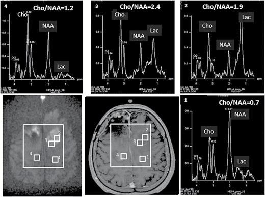 Two new enhanced lesions were observed in a GBM 19 months post-RT (middle panel on the second row). High b-value diffusion imaging (b = 3000 s/mm2, left panel on the second row) indicated that the lesion in the left frontal lobe had hypercellularity suggesting tumor recurrence, while the lesion in the right frontal lobe had cellularity similar to normal tissue suggesting treatment effect. Results from high b-value DWI are similar to proton spectroscopic imaging, as elevated Cho/NAA ratios (2.4-1.9) and increased lactate (2 right panels on the first row) were observed in the left lesion but close to normal Cho/NAA ratio (1.2) and minimum lactate in the right lesion (left panel on the first row). Note that high b-value diffusion imaging only takes approximately one minute to acquire.