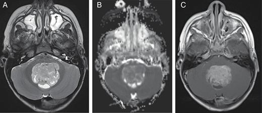 A 4-year-old boy with medulloblastoma. (A) Axial T2 image demonstrates T2 hypointense mass with posterior cysts in the fourth ventricle. (B) Axial apparent diffusion coefficient map image demonstrates restricted diffusion within the mass. (C) Axial T1 postcontrast image demonstrates enhancement in the mass, posterior cysts, and leptomeningeal seeding in bilateral internal auditory canals.
