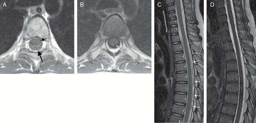 (A) Axial T1-weighted image at the level of the carina. Image was obtained using an interleaved slice acquisition order. Prominent CSF pulsation artifacts (long black arrow) are present around the spinal cord (short black arrow). These pulsation artifacts can obscure subarachnoid metastatic deposits. (B) Axial T1-weighted image obtained a few days later, without use of interleaved image acquisition. The spinal cord is well demarcated from the surrounding T1 hypointense CSF. (C) Sagittal 2D FSE T2 of the upper spine of the same patient. Many hypointense artifacts (arrows) are evident within the CSF surrounding the spinal cord. These artifacts are produced by physiologic CSF pulsation and could obscure subarachnoid metastatic deposits. (D) Sagittal 3D FIESTA T2-weighted image obtained a few days later. CSF has a homogeneous T2 hyperintense (myelographic) appearance, which increases sensitivity to the presence of lesions within the thecal sac.