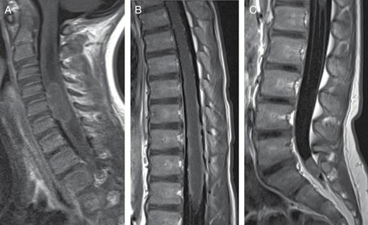 A 4-year-old girl with medulloblastoma. (A) Sagittal T1 postcontrast image of cervical spine demonstrates large nodule on ventral surface of cervical spinal cord and leptomeningeal laminar seeding. (B) Sagittal T1 postcontrast image of thoracic spine demonstrates linear leptomeningeal seeding along surface of thoracic spinal cord. (C) Sagittal T1 postcontrast image of lumbar spine demonstrates nodule in distal thecal sac.