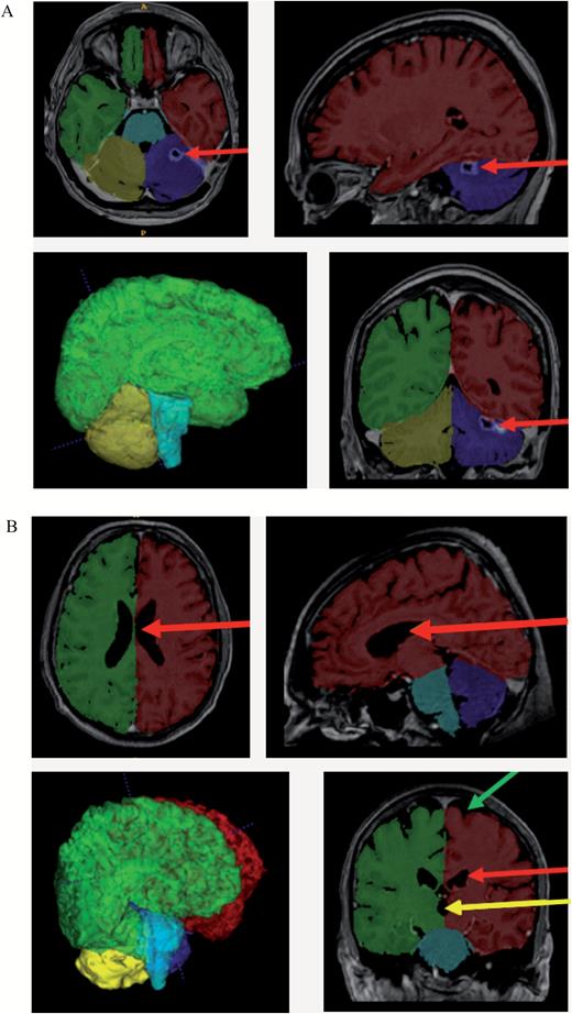 Visualization of the results of the volBrain segmentation process with ITK-SNAP. (A) MRI scan of a 45-year-old woman 129 days after commencing WBRT. VolBrain correctly identified the resection cavity in the left cerebellar hemisphere as not being brain tissue (red arrow). The image in the lower-left corner depicts a 3-dimensional reconstruction of the segmentation result created by volBrain. (B) MRI scan of a 68-year-old man 96 days after commencing WBRT. VolBrain exactly differentiated between brain tissue on the one hand and cerebrospinal fluid in the ventricles (third ventricle: yellow arrow; lateral ventricles: red arrow) and subarachnoid space (green arrow) on the other. Description of the segmentation labels: red, left cerebral hemisphere; green, right cerebral hemisphere; blue, left cerebellar hemisphere; yellow, right cerebellar hemisphere; turquoise, brainstem; gray tones, area identified as nonbrain tissue.