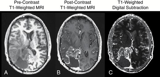 (A) Precontrast T1-weighted MR image; (B) postcontrast T1-weighted MR image; and (C) contrast enhanced T1-weighted digital subtraction maps in a patient with recurrent glioblastoma.