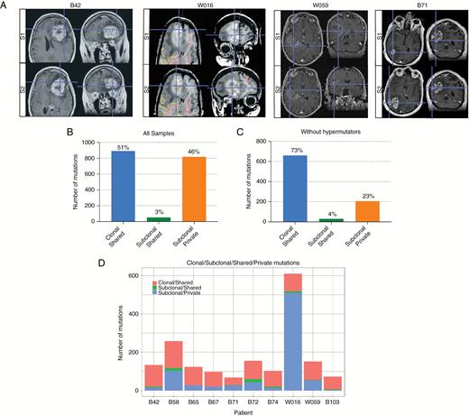 Mutational heterogeneity between tumor sectors. (A) Representative T1-weighted MRIs for patients B42, W016, W059, and B71 illustrating the coordinates of 2 distinct tumor biopsy regions (S1 and S2) in the axial and coronal planes. (B, C) Charts depicting the proportions of clonal-shared, subclonal-shared, and subclonal-private mutations for the entire study cohort (B) and 8 non-hypermutant cases (C). (D) Chart showing the overall numbers of clonal-shared, subclonal-shared, and subclonal-private mutations for each patient. (E) Representative VAF versus somatic mutation plots illustrating mutational heterogeneity between 2 distinct tumor sectors (S1 and S2) for patients B72 (left) and W059 (right). (F) Waterfall plot highlighting regional heterogeneity of somatic mutations in a subset of recurrently mutated cancer-associated genes. Mutation frequencies for each gene for all tumor regions sequenced are depicted on the left. (G) Plot of the VAFs of clonal mutations in each tumor sector normalized to the median VAF of all clonal mutations in that specific sector (black dots). The VAFs of TERT promoter mutations (G228A and G250A) are indicated in red. For patient W059, the TERT promoter region was amplified, thus VAFs after copy number correction are shown.