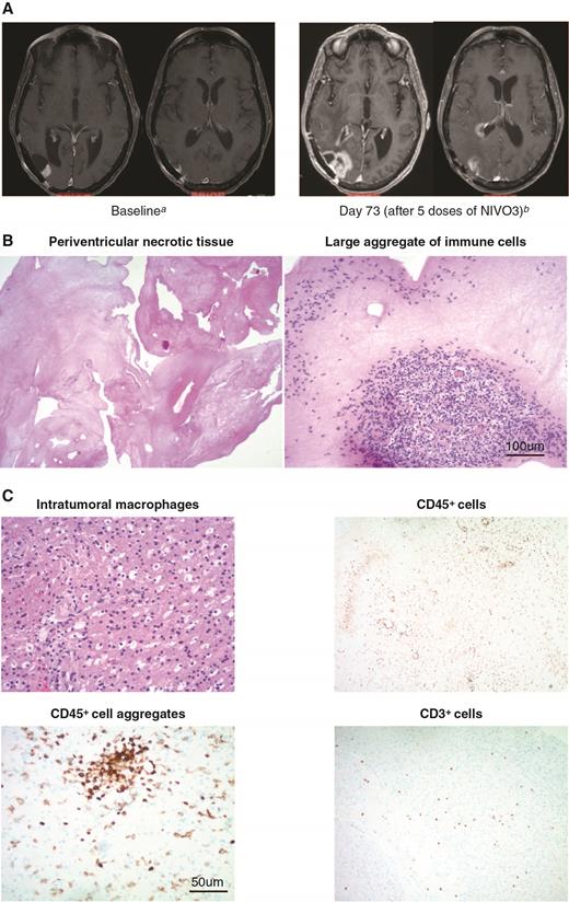 A patient case depicting immune-mediated effects of therapy is presented. (A) MRI scans from a 67-year-old patient treated with NIVO3 who had suspected disease progression, with an increase in lesion size from 12 mm at baseline (left) to 40 mm at day 73 (right). MRI scans were conducted using the same parameters for each scan. (B) Resected tumor at day 81 stained with hematoxylin and eosin indicating immune-mediated changes in lesion size consistent with large aggregates of immune cells (right) and extensive tumor necrosis (left). Scale bar denotes 100 μm. (C) Immunohistochemistry of resected tumor specimens depicts infiltrating immune cell aggregates, T cells, and macrophages. Scale bar denotes 50 μm. a12-mm temporal lobe lesion; no corticosteroid treatment. b40-mm temporal lobe lesion; patient received concomitant methylprednisolone 16 mg/day.