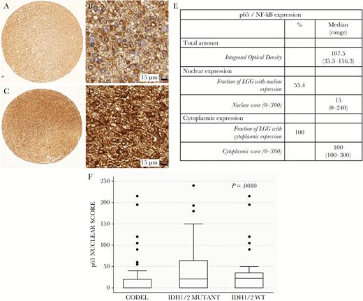 Expression of NF-κB-p65 protein in TMA comprising 146 grade II LGGs. (A–D) Representative pictures of the immunohistochemical detection of NF-κB-p65 in the 1-mm cores of LGG presenting the protein only in the cytoplasm (A–B) or in both the cytoplasm and the nucleus (C–D). (E) Table summarizing the quantification of total amount, nuclear expression, and cytoplasmic expression of p65 NF-κB-p65. (F) Nuclear expression of NF-κB-p65 (expressed as nuclear score) in the 3 molecular classes. Data are presented as box and whiskers. CODEL = gliomas IDH1/2 mutant and 1p/19q codeleted; IDH1/2 MUTANT = gliomas IDH1/2 mutant but not 1p/19q codeleted; IDH1/2 WT = gliomas without IDH1/2 gene mutation