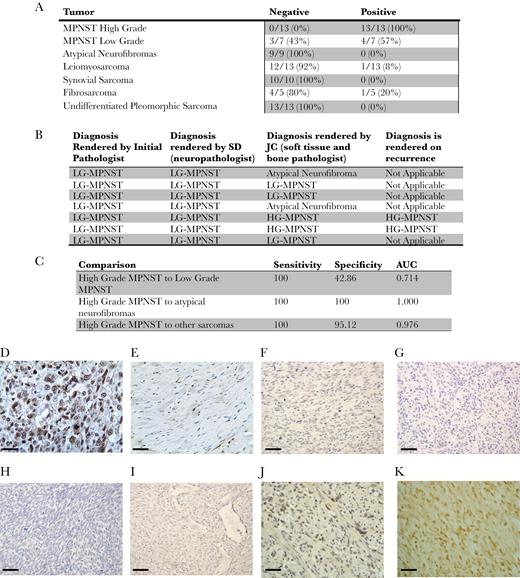 β–III-spectrin immunostaining in MPNSTs and other sarcomas. (A) Positive β–III-spectrin immunoreactivity was detected in 100% (13/13) of HG-MPNSTs, 25% (4/16 tumors) of LG-MPNSTs or atypical neurofibromas, and 5% (2/41 tumors) of the other sarcomas. (B) Two of 7 LG-MPNSTs were called HG-MPNST by one of the reviewing pathologists based on a mitotic count of >10/10 HPF. Both of these cases displayed β–III-spectrin immunoreactivity and ultimately recurred as HG-MPNSTs. (C) The sensitivity and specificity of β–III-spectrin immunostaining for high-grade MPNSTs is shown. (D–K) Positive β–III-spectrin immunostaining in a representative (D) HG-MPNST, which was not observed in (E) normal peripheral nerve, (F) leiomyosarcomas, (G) undifferentiated pleiomorphic sarcomas, (H) synovial sarcomas, or (I) fibrosarcomas. More challenging cases are depicted in (J) “negative” LG-MPNST with weak to moderate staining in <50% of cells and (K) “positive” LG-MPNST with moderate to strong staining in 90% of cells. Scale bar, 40 μm. Atypical neurofibroma: tumor with cellular atypia alone. LG-MPNST: tumor with cellular atypia, a low mitotic index (<10/10 HPF), and sometimes increased cellularity. HG-MPNST: tumor with high cellularity, nuclear atypia, and brisk mitotic activity (≥10/10 HPF).
