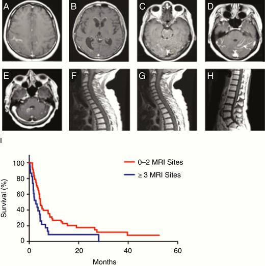 Eight defined sites of radiographic involvement of LC-LM. (A) Cerebrum. (B) Ventricle. (C) Brainstem (pons and medulla included in this category). (D) Cerebellum. (E) Cranial nerves. (F) Cervical spinal cord. (G) Thoracic spinal cord. (H) Lumbosacral spinal cord. (I) Among the 76 patients with complete staging of LC-LM who did not receive bevacizumab within 30 days prior to MRI, there was a significantly increased risk of death with 3+ radiographic sites of disease versus 0–2 sites of disease (HR for 3+ sites of disease: 1.95; 95% CI: 1.16–3.30; P = 0.01).