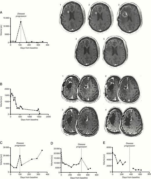 (A–E) Tumor volume change over time in radiographic responders from the primed combination group. Patients in the primed combination group exhibiting radiographic evidence of tumor shrinkage on VB-111 monotherapy prior to progression. Vertical line = time of noted disease progression. Dashed lines showing volumes to the left of the vertical line indicate time on VB-111 monotherapy, while dotted lines to the right of the vertical lines indicate time on combination VB-111 and bevacizumab. 2A, 2B: MRI series of 2 of the radiographic responders demonstrating specific radiographic changes: characteristic, expansive areas of necrosis in the areas of initial enhancing disease (2B), and pseudoprogression (2A).
