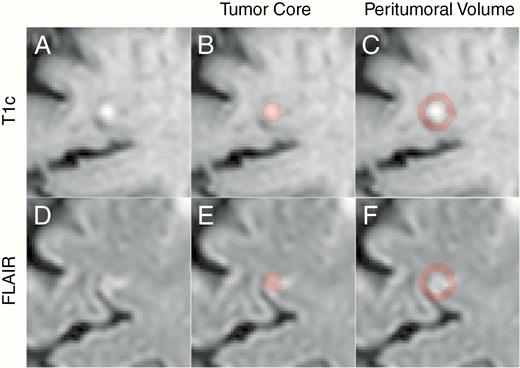 Axial slice centered on a BM as it appears on T1c (A) and FLAIR (D) scans. Highlighted regions represent the tumor core and peritumoral volume on T1c (B and E, respectively) and FLAIR (C and F, respectively).