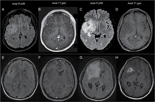 Radiological patterns of progression in IDHwt grade II gliomas. Panel A-D: example of an infiltrative pattern of progression. Compared with images at diagnosis (panel A, B), images at progression (panel C, D) show a substantial extension of tumor infiltration along the right temporal and insular lobe and the ipsilateral thalamus (panel C), without the appearance of enhancing abnormalities (panel D). Panel E-H: example of a nodular pattern of progression. Compared with images at diagnosis (panel E, F), images at progression (panel G, H) show the appearance of a gross nodule of contrast enhancement in the right insula (panel H), surrounded by extensive perilesional edema (panel G, H).