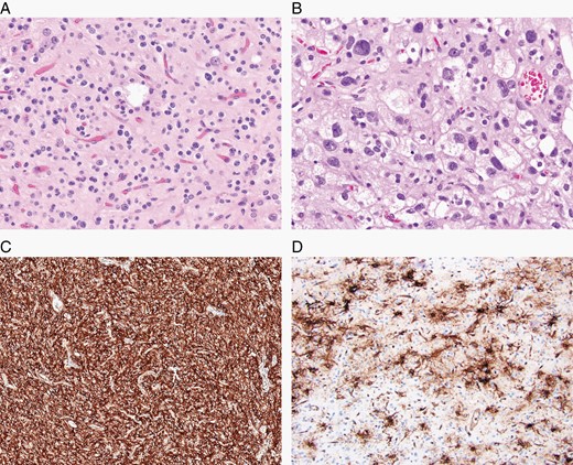 Polymorphous low-grade neuroepithelial tumor of the young (PLNTY) is a glial neoplasm associated with a history of epilepsy in young people, diffuse growth patterns, frequent presence of oligodendroglioma-like components, calcification, CD34 immunoreactivity, and MAPK pathway-activating genetic abnormalities. (A) Common oligodendroglioma-like appearance (H&E, ×200), but (B) histological appearances can vary greatly within tumors (H&E, ×400). (C) CD34 immunostaining is typically strong and diffuse in the tumor (×100); and (D) is often found in the peritumoral cortex (×200).
