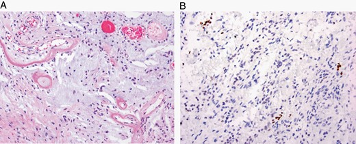 Desmoplastic myxoid tumor of the pineal region, SMARCB1-mutant is a rare pineal-region tumor that features desmoplasia and myxoid changes (H&E, ×200) (A) as well as loss of INI1 staining (×200) (B).