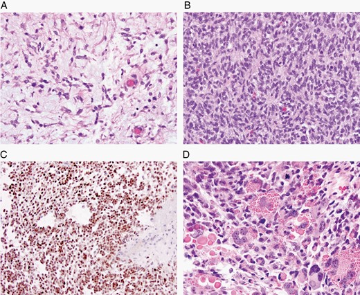 Newly recognized mesenchymal, non-meningothelial tumors of uncertain histogenesis. (A) Intracranial mesenchymal tumor, FET-CREB fusion-positive (H&E, ×200); these tumors have variable morphology and a fusion of an FET RNA-binding protein family gene and a member of the CREB family of transcription factors. (B, C) CIC-rearranged sarcoma, with (B) poorly differentiated cells (H&E, ×200) and (C) with ETV4 frequently being upregulated in these tumors (×200). (D) Primary intracranial sarcoma, DICER1-mutant with characteristic eosinophilic cytoplasmic droplets (H&E, ×200).