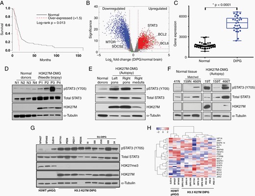 STAT3 is activated at Y705 in H3K27M-mutant DMGs. (A) Kaplan–Meier curve illustrating overall survival of patients with pediatric high-grade glioma (pHGGs) and relatively high STAT3 expression (Z ≥ 1.5× normalized mean) versus all other pHGGs (N = 211). (B and C) Differential gene expression analysis of diffuse intrinsic pontine gliomas (DIPGs); DIPG is kept as the disease designation as data were obtained in the pre-K27M era. (D–F) Western blot analysis of H3K27M-mutant DMG tumor specimens or nonneoplastic control tissue, as indicated. Two patients (159 and 466) had matched normal tissue for analysis. (G) Phospho-STAT3 (pSTAT3) expression in patient-derived H3-wildtype and H3K27M-mutant cell lines. (H) Heatmap of RNA-Seq normalized reads of known genes associated with STAT3 signaling.