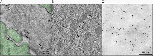 GBM-derived EVs: (A) Transmission electron micrograph of GBM tissue (green) releasing vesicles in the extracellular space. EXOs are shown by white arrows, whereas MVs and LOs are shown by black arrows (magnification × 25 000). (B) Transmission electron micrograph of GBM tissue containing MVBs (black arrows) with several EXOs inside (magnification × 14 500). (C) Transmission electron micrograph of EVs isolated from the plasma of a patient with GBM after immunogold labeling. The different EV subpopulations, EXOs (gray arrows) and MVs and LOs (black arrows) are classified by morphological features, similarly to that identified in GBM tissue and are stained with a mouse anti-CD9 primary antibody (1:10, BD Pharmingen), followed by a rabbit antimouse IgG bridge antibody (1:250, Dako) and protein A gold 10 nm (PAG10, 1:50).