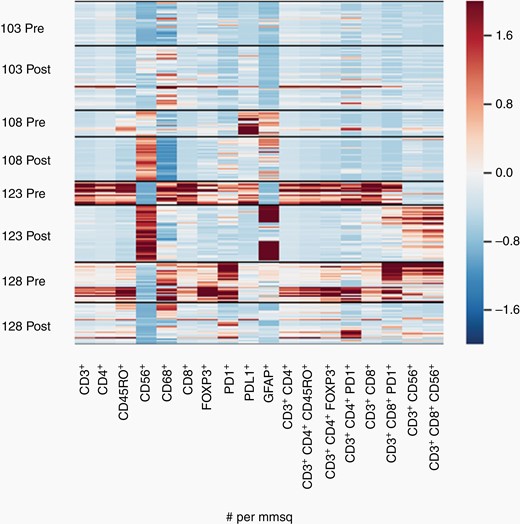 Heat Map constructed from quantitative image analyses of multiplex immunofluorescence (MultiOmyx™ High-Order Multiplexing) images from 4 matched pairs of tumor samples pre- and post-treatment. Ratios are expressed as positive cells per mm2 of tissue (density). The panel consists of markers covering the following immunophenotypes: CD3+ (pan T cells), CD3+ CD4+ (helper T cells), CD3+ CD8+ (cytotoxic T cells), CD3+ CD8+ CD56+ (NKT cells), CD3+ CD4+ FOXP3+ (regulatory T cells), and PD-1+ and PD-L1+ total immune cells. CD56+ cells may include NK cells but have been confounded by expression of NCAM on tumor cells (not shown). Structural marker Glial Fibrillary Acidic Protein (GFAP) expression is expected to be higher in tumor than normal adjacent brain tissue or nontumor gliosis. The apparent row width varies because the number of bands depends on the number of regions of interest (ROI) analyzed per sample, as compared with conventional heat maps for a homogenized tumor sample or liquid specimen (see Materials and Methods). Refer to Supplementary Table 1 for corresponding subject characteristics and the treatment group assigned.