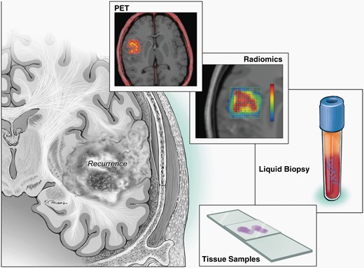 Schematic demonstrating techniques for disease monitoring, such as liquid biopsies, radiomics, repeat biopsies, traditional MRI images.