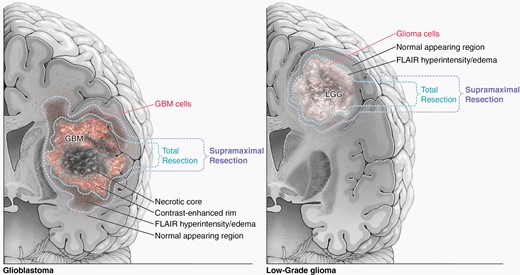 Illustration showing supramaximal resection definitions for high-grade (a) and low-grade (b) gliomas.