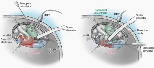 Illustration showing cortical and subcortical monopolar and bipolar mapping techniques.