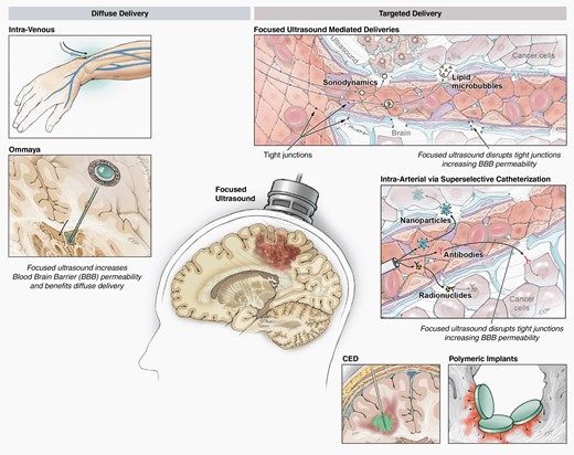 Drug delivery strategies/adjuncts that involve neurosurgeons, such as convection-enhanced delivery, radiation implants, low frequency focused ultrasound.