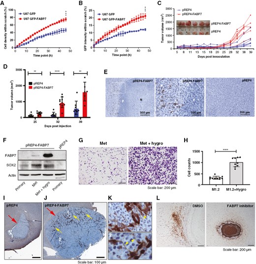 Fatty acid-binding protein 7 (FABP7) drives xenograft GBM growth and metastasis. (A) Real-time dynamic changes incell density in the scratch as a function of migration start time (Incucyte). (B) Real-time dynamic changes in the percentage of GFP intensity within the closing gap (Incucyte). (C, D) Tumor volume as a function of days post injection of U87-pREP4 and U87-pREP4-FABP7 cells in the flank of nude mice (C) and statistical analysis of tumor volume (D) at specific time points (inset shows photograms of tumors). (E) Representative images showing FABP7 immunostaining in xenograft tumors generated from FABP7-expressing (pREP4-FABP7; left, middle – magnification of the squared area of the left panel) and control (pREP4) U87 cells (right panel). (F) Western blot showing expression of FABP7 and SOX2 in primary cultures of xenograft tumor tissues, as well as in intestinal metastasis cultured in the absence and presence of hygromycin. (G) Representative images of Transwell assay comparing migration of the intestinal metastasis-derived cells without (Met) or with hygromycin selection (Met + hygro). (H) Histogram showing quantification and statistical significance of the results obtained using the Transwell assay. (I-K) Representative images of tumors formed from U87 pREP4 (I) and U87-pREP4-FABP7 (J) cells orthotopically injected into the brains of NSG mice. Magnified images (K) show the morphology of FABP7-positive cells from the indicated areas in M with arrowheads indicating extended cell processes. Large arrows in I and J point to tumors. Small arrows in J point to FABP7 immunoreactive cells. (L) Representative images showing the distribution of A4-007 FABP7-positive cells orthotopically injected into the brains of NSG mice (left panel), and the effect of intraperitoneal injection of the FABP7 inhibitor SBFI-26 on tumor formation (right panel). The flank xenograft experiments were performed twice with 6 mice in each group per experiment and the two orthotopic xenograft experiments were each carried out once with 3 mice in each group. P denotes pseudopalisade. N, necrosis. **, P < .01. ***, P < .001. ****, P < .0001.