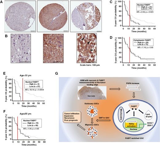 Immunohistochemical analysis of a GBM TMA. (A) Representative immunostaining images showing negative (left panel), uniform strong cytoplasmic and nuclear (middle panel), and heterogenous intratumoral and subcellular distribution of Fatty acid-binding protein 7 (FABP7) (right panel). (B) Magnified images from the squared regions shown in (A). Arrowheads point to FABP7 immunoreactivity in cell nucleus. (C, D) Patient overall survival (OS) curves generated based on FABP7 nuclear (C) and cytoplasmic immunoreactivity (D). (E, F) Patient overall survival curves generated based on nuclear FABP7 immunoreactivity in a patient population under (E) or above (F) the median age of 55. Three to six cores from each tumor on TMA slides were immunostained and scored. HR denotes hazard ratio. Scale bars: 100 μm. (G) Graphical summary of the role of the FABP7-RXRα neurogenic pathway in determining stationary to migratory transition in GSC and tumor progression.