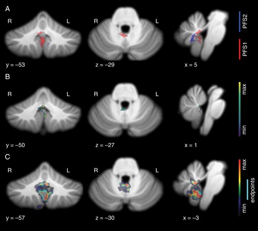Lesion patterns observed in speech-impaired subjects at initial postoperative imaging. (A) Voxel-wise results show significant incidence of damage in the right fastigial nucleus, proximal superior cerebellar peduncles, and inferior vermis in subjects with complete mutism (P < .001). Subjects with paucity of speech showed damage in right vermal lobule VIIIb, in gray and white matter proximal to the fastigial nucleus (P < .001). (B) Result of lesion-symptom mapping. Voxel color represents positive association with PFS1 diagnosis, with peak finding at the cerebellar commissure, where output tracts from bilateral fastigial nuclei decussate. Additional peak is present at left lobule IX. (C) Result of graph-pattern analysis showing significant involvement of the right fastigial nucleus as a damage endpoint and left fastigial nucleus as contingent damage for CMS-unique lesion patterns. Inferior vermis and bilateral lobule IX also showed significant incidence in CMS-unique damage.