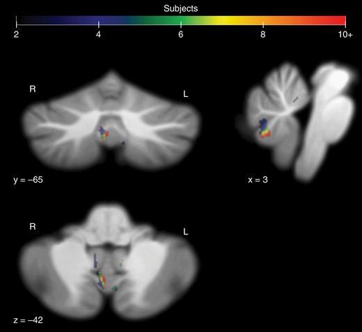 Voxels containing surgical damage in CMS subjects (PFS1 and PFS2) that did not appear in any asymptomatic subjects at the initial postoperative image session. Damage occurred in 16 of the 52 combined CMS subjects at the listed coordinates for the right side of vermal lobule VIIIa.