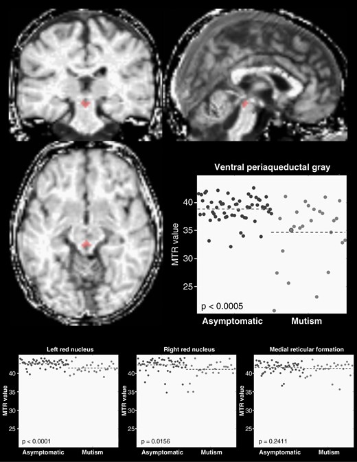 Late (>1 year) postoperative differences in magnetization transfer ratio of anatomical targets of cerebellar output. Normalized whole-brain MTR image shows an example ventral PAG ROI in red for an individual subject with postoperative CMS. Scatterplots show MTR values for individual subjects both asymptomatic (dark gray) and with CMS (light gray; large dot in the ventral PAG plot represents MTR value of the example subject). Decreased MTR values in CMS suggest demyelination as a feature of CMS, likely due to surgical injury of afferent fibers in the cerebellum, or secondary cell injury caused by excitotoxicity. Significant decrease in MTR was observed in the ventral PAG and the red nuclei bilaterally, although group differences were more consistent within the left red nucleus. No CMS-related difference in MTR was observed in the medial reticular formation.