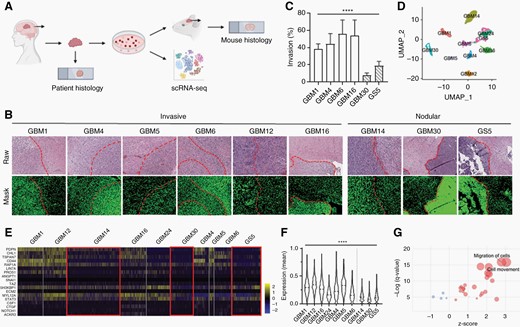 Histopathological and scRNA-seq analysis identify two cohorts of GBM samples with distinct phenotypes, invasive and nodular.