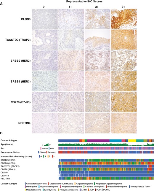 Immunohistochemical analysis of ADC target protein expression in human tumor tissue. To directly analyze ADC target antigen expression in human tumor tissues and explore the feasibility of antibody markers for clinical screening, we developed immunohistochemistry (IHC) assays for a selected group of ADC targets, including HER2, HER3, TROP2, B7-H3, NECTIN4, CLDN6, and CLDN18.2. Target marker expression was semi-quantitatively (0–3+) scored by a pathologist, with the same scoring system and relative intensity for any tumor type. Representative staining for each marker is shown in samples from AT/RT (CLDN6), craniopharyngioma (TROP2), ependymoma (HER2), and meningioma (HER3, NECTIN4, B7-H3) specimens (A). A cohort of 575 human CNS tumors from diverse histologic subtypes were stained by IHC using tissue microarrays (TMA) and whole-slide sections (WSS). These data were correlated with clinicopathologic data for each case, showing distinctive patterns of ADC target marker expression in each subtype (B). Scale bars 50 μm.