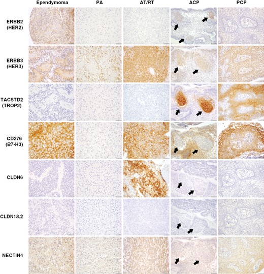 Characterization of ADC target proteins in pediatric and rare brain tumors. Immunohistochemistry for ADC targets was performed in a broad panel of pediatric CNS tumors, including pilocytic astrocytoma (PA), ependymoma (EPN), atypical teratoid/rhabdoid tumor (AT/RT), adamantinomatous craniopharyngioma (ACP), and papillary craniopharyngioma (PCP). HER2 showed moderate-strong expression in ependymoma, as well as region-specific expression in whorled epithelial cells in ACP (arrows). HER3 was expressed by all tumor subtypes, with frequent strong expression in ependymoma, AT/RT, and PCP, as well as expression in whorled cells in ACP. TROP2 showed strong/diffuse expression in all PCP examined, and exceptionally strong expression in whorled epithelial cells in ACP. B7-H3 was moderately to strongly expressed by all tumors except PA. In contrast to prior markers, B7-H3 was expressed by basaloid rather than whorled cells in ACP. CLDN6 was uniquely and strongly expressed by AT/RT. No expression of CLDN18.2 was identified in any tumor subtype. NECTIN4 typically showed weak-moderate expression in each tumor subtype.