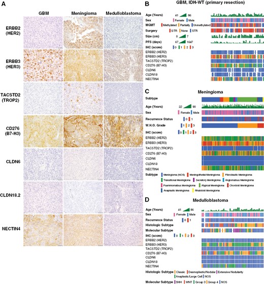 Characterization of ADC target protein expression in brain tumors by histologic and molecular subtype. Immunohistochemistry for ADC target antigens were analyzed in common adult and pediatric CNS tumors by histologic and molecular subtype, including GBM, meningioma, and medulloblastoma. GBM, meningioma, and medulloblastoma frequently show moderate-strong expression of HER3, B7-H3, and NECTIN4. There was no expression of CLDN6 or CLDN18.2 in GBM, meningioma, or medulloblastoma. Meningiomas frequently exhibited weak-moderate expression of HER2, while this antigen target was absent in GBM and medulloblastoma. While TROP2 was absent in GBM and medulloblastoma, meningiomas rarely showed expression of TROP2 in scattered tumor cells (A). Sub-group analysis of primary IDH-WT GBM cases (n = 58) showed a typical distribution of clinicopathologic characteristics but no definite correlations with ADC marker expression (B). Meningiomas (n = 234) were stratified according to WHO histologic group, revealing that rare cases with TROP2 expression are predominantly secretory meningiomas, while chordoid meningiomas show lower expression of HER2 and B7-H3 (C). Analysis of medulloblastoma cases (n = 49) by molecular and histologic subtype revealed lower expression of HER3 and B7-H3 in SHH-group tumors, with no definite correlation with histologic subtype (D).